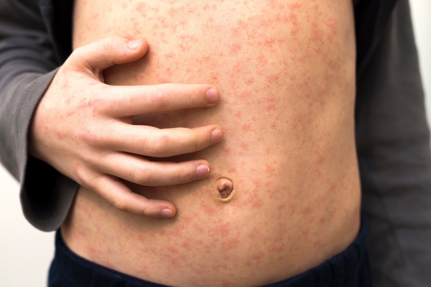 Sick Child Body, Stomach with Red Rush Spots from Measles or Chi